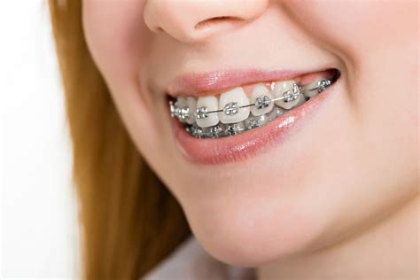 metal brackets ortho|traditional metal braces for adults.